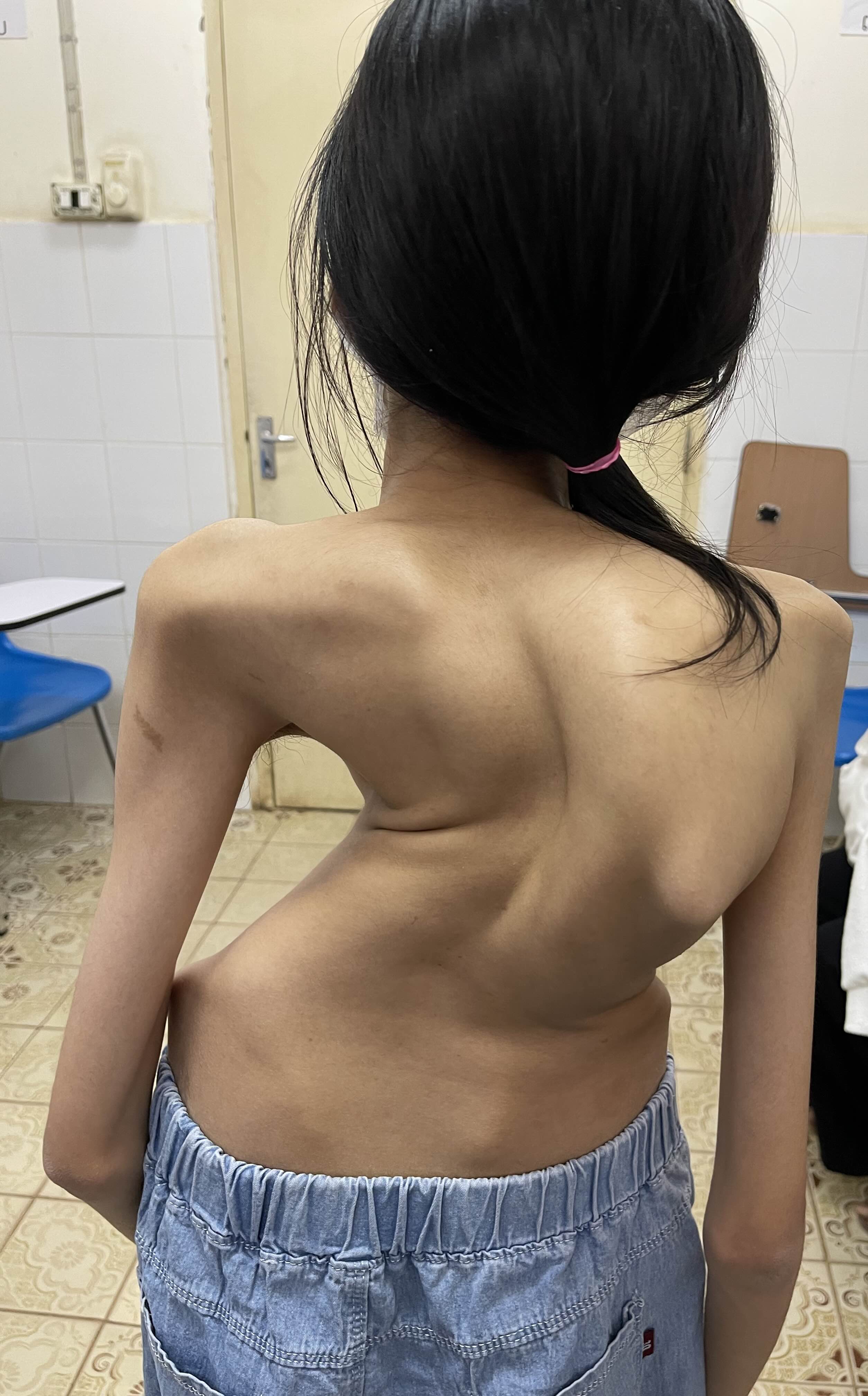 Patient with severe scoliosis seen from behind during an evaluation in Laos